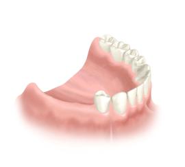 Computernavigierte Implantologie, 3 Zähne werden ersetzt